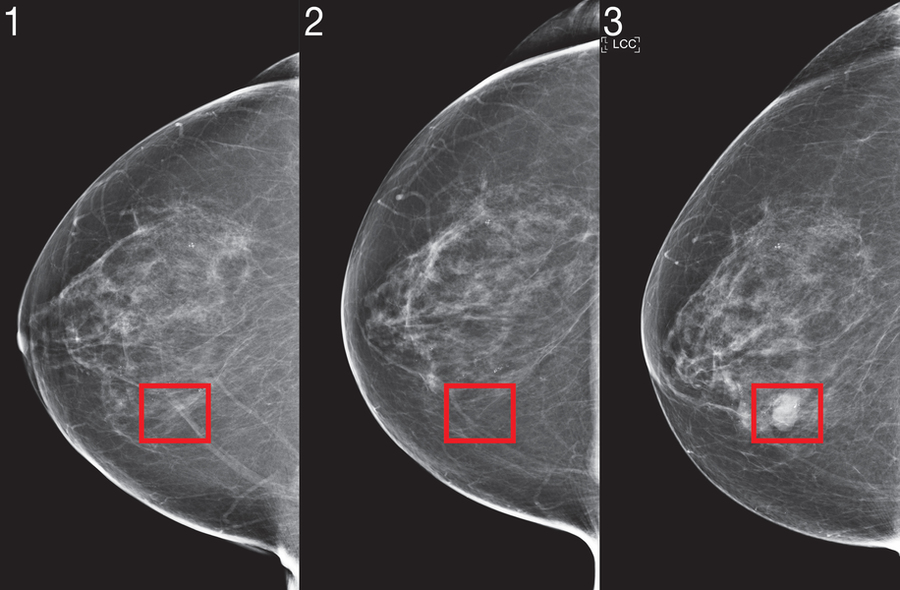 Mammographic Mass Data Set
